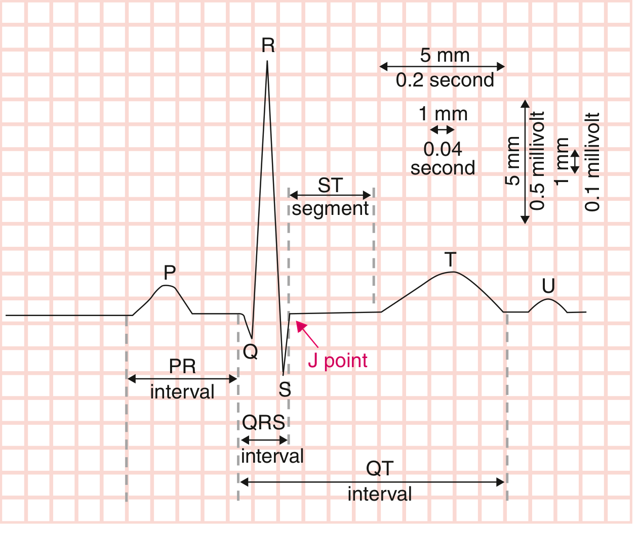 ECG grid with labeled boxes and measurements