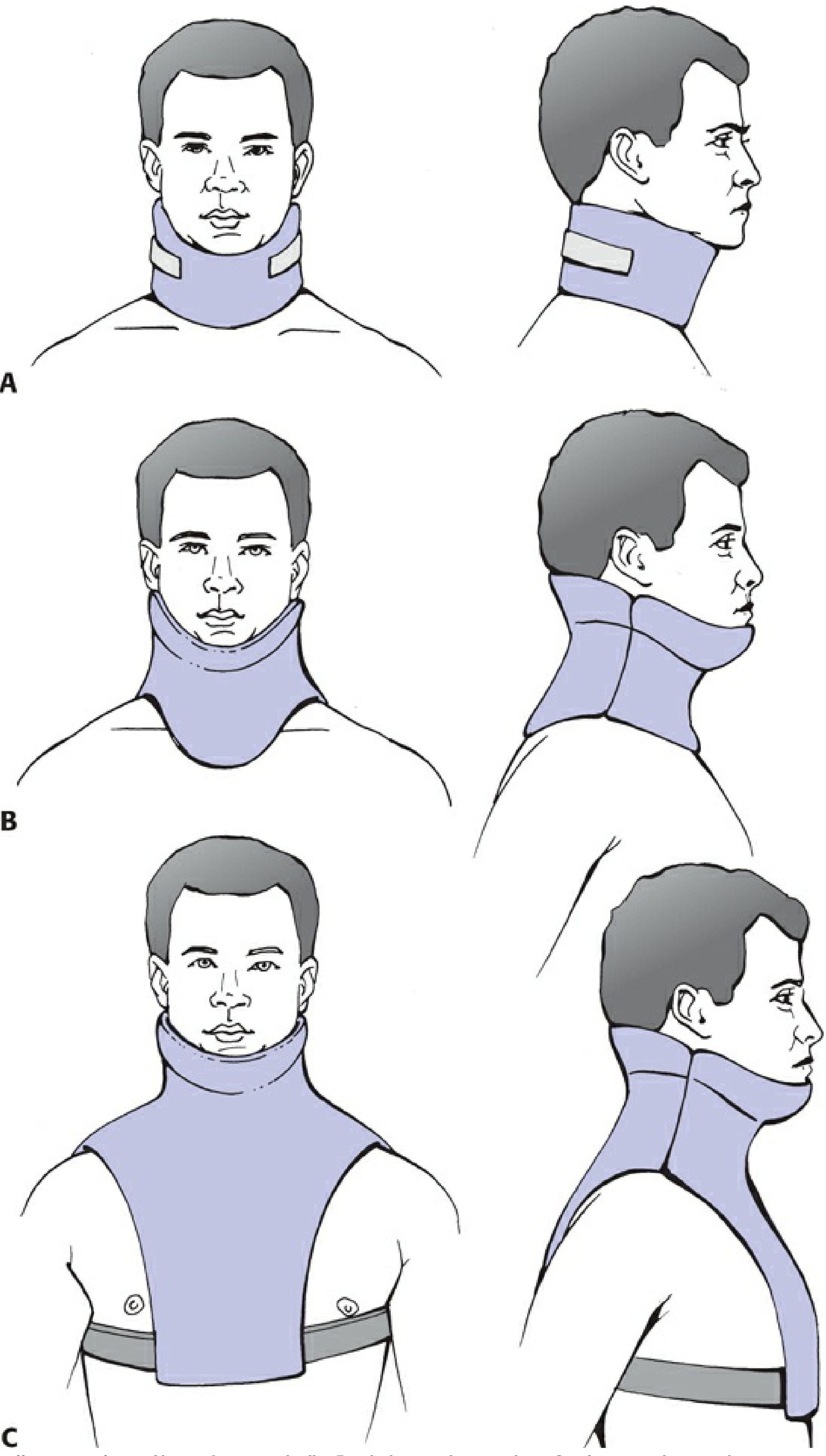 Types of cervical braces - cervical collar, high cervicothoracic orthosis, low cervicothoracic orthosis
