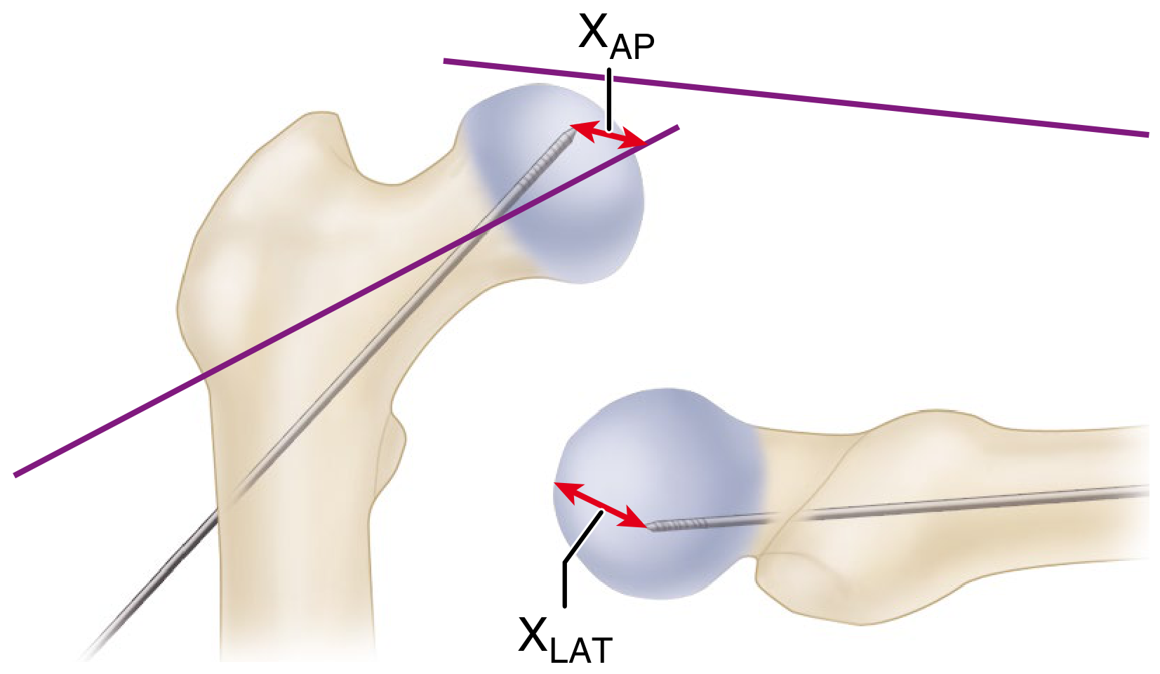 TAD Calculation - distances from screw tip to femoral head apex on AP (X_AP) and lateral (X_LAT) views