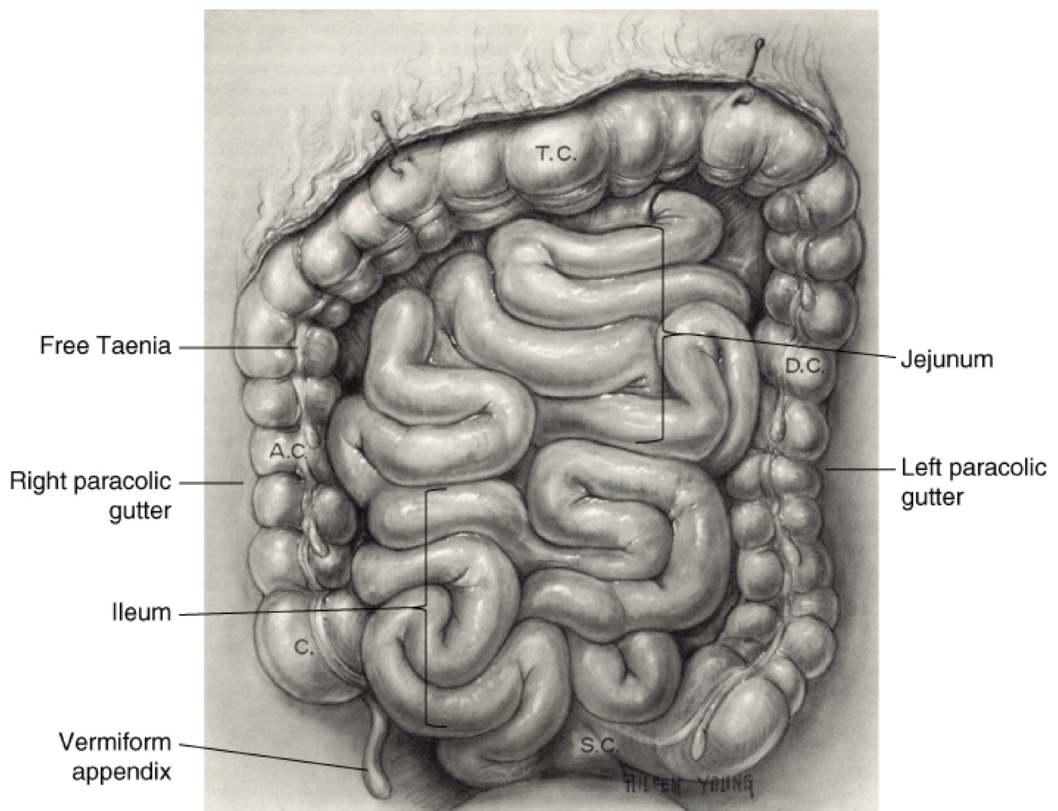 Intraoperative view of the large intestine showing T.C. (transverse colon), A.C. (ascending colon), D.C. (descending colon), S.C. (sigmoid colon), C (cecum), vermiform appendix, jejunum, ileum, free taenia, and right and left paracolic gutters - Fischer's Mastery of Surgery