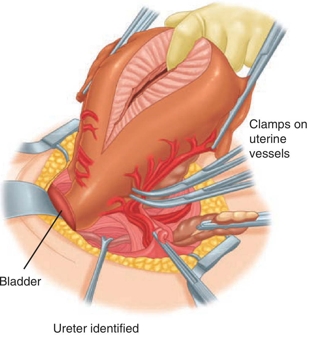 Peripartum hysterectomy - clamps on uterine vessels with bladder and ureter identified