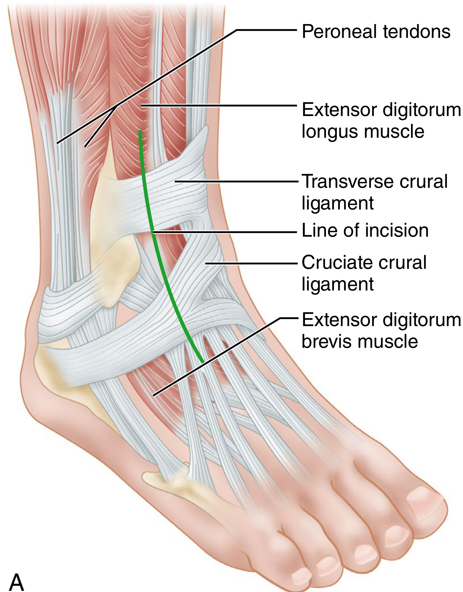 Anterolateral approach anatomy - showing line of incision relative to extensor tendons, peroneal tendons, and cruciate/transverse crural ligaments
