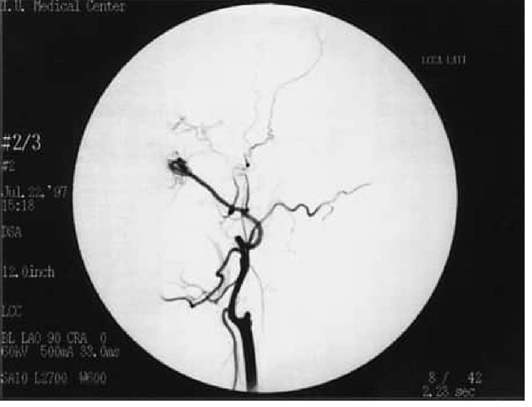 Cerebral angiogram showing branching brain vessels