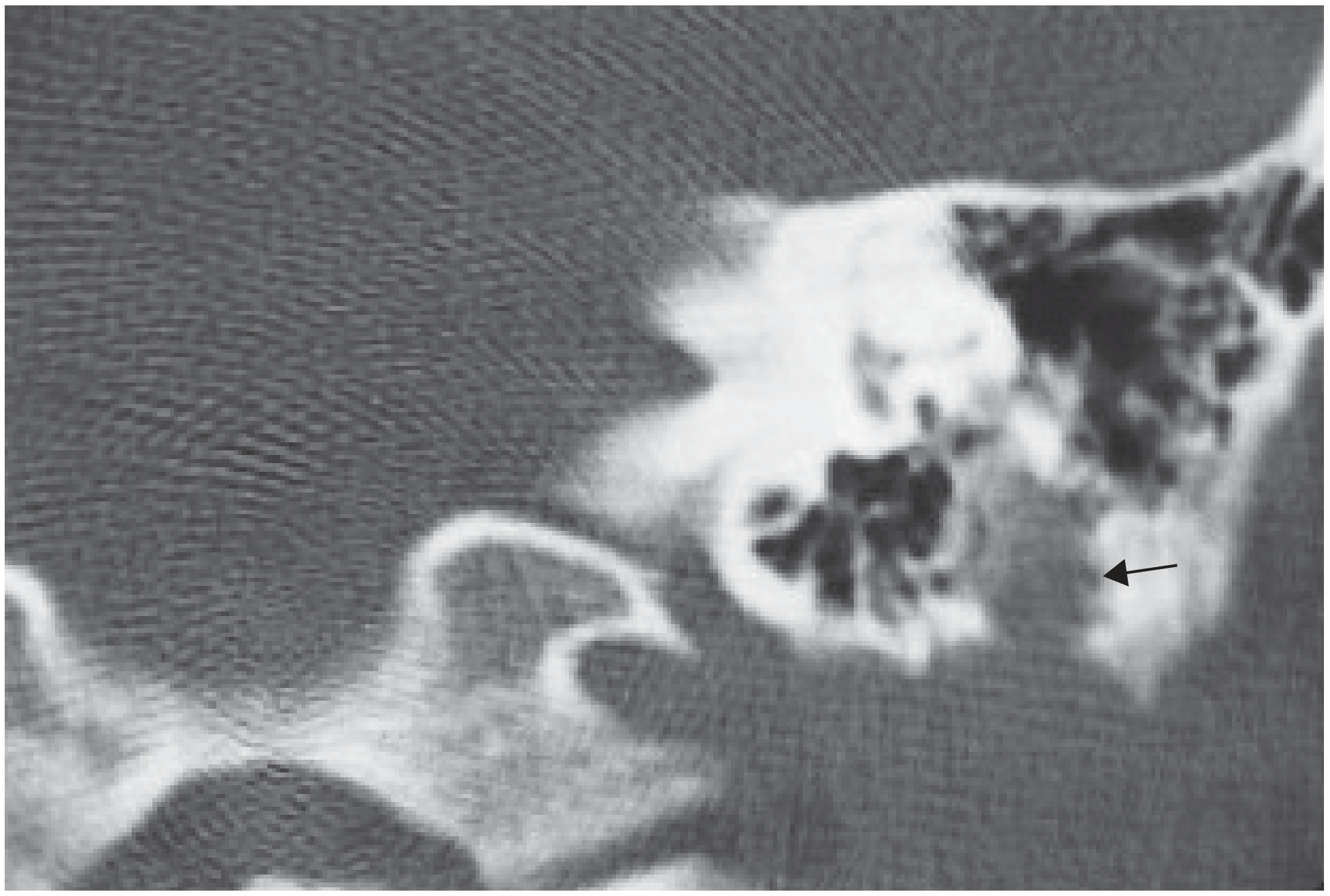 CT: facial nerve schwannoma in Fallopian canal - expanded canal with scalloped bony margins (arrows)
