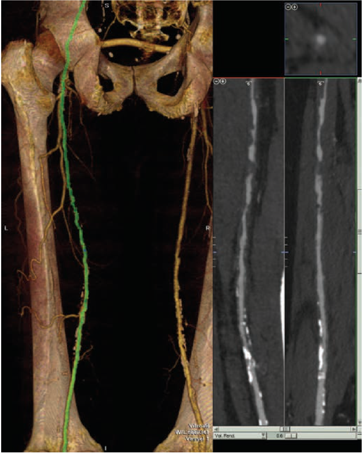 CTA of Lower Extremity Arteries