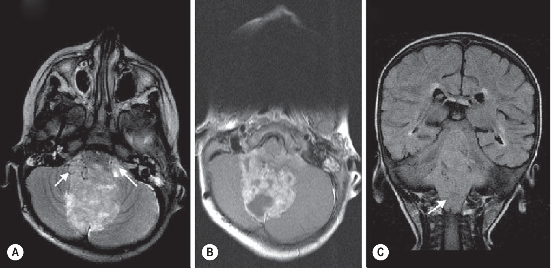 Ependymoma - axial T2 (A), enhanced T1 (B), coronal FLAIR (C): solid and microcystic 4th ventricular tumor with characteristic extension through foramina of Luschka, Magendie and foramen magnum (arrows)