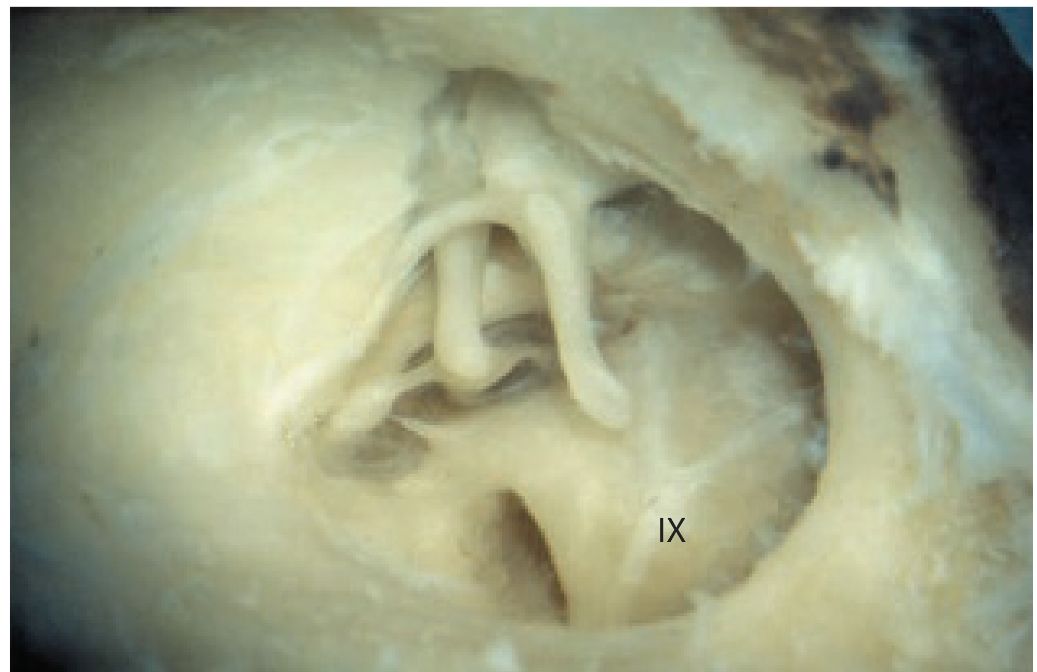 Medial wall of mesotympanum - cadaveric specimen showing tympanic branch of CN IX (IX) crossing the promontory