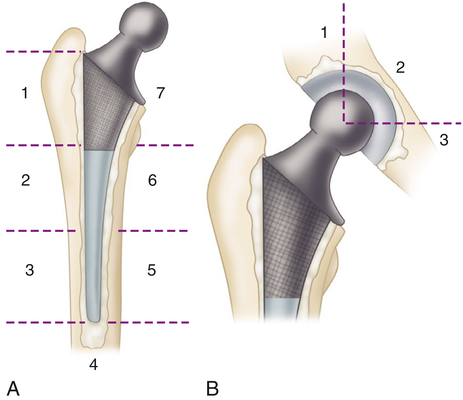 Gruen Zones (femur) and DeLee & Charnley Zones (acetabulum)