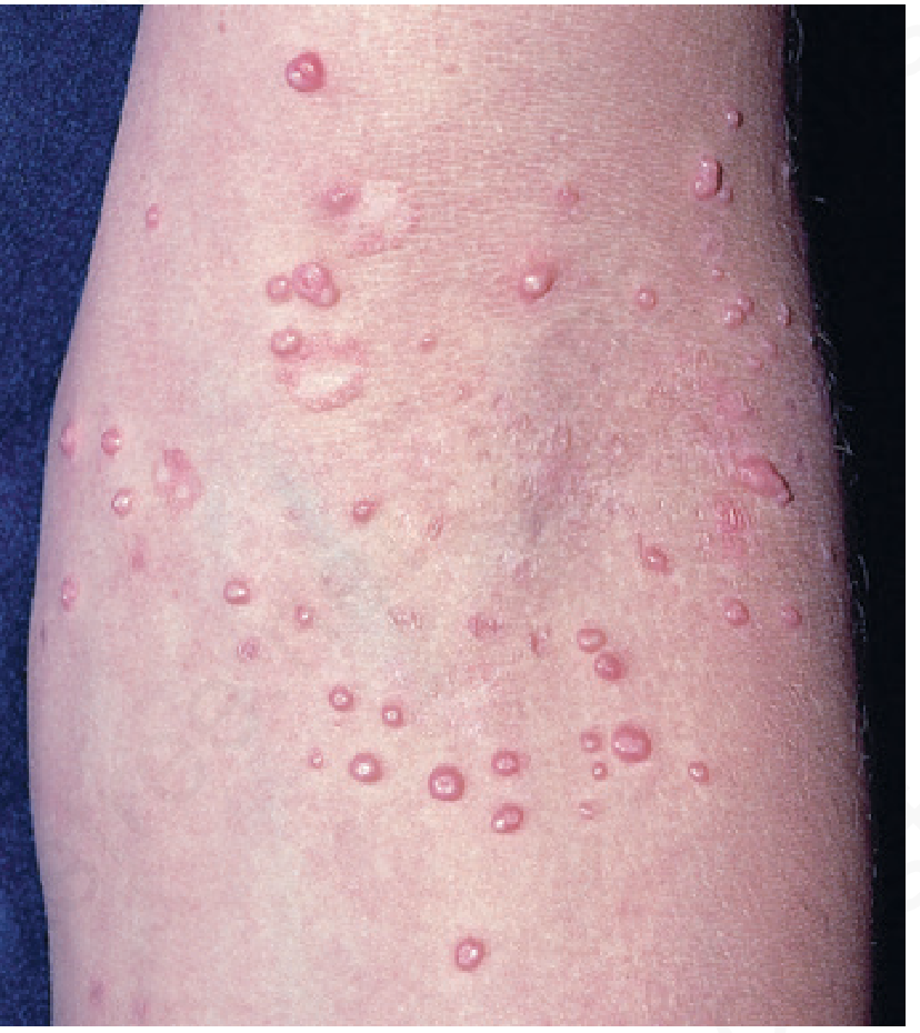 Molluscum contagiosum in child - textbook reference
