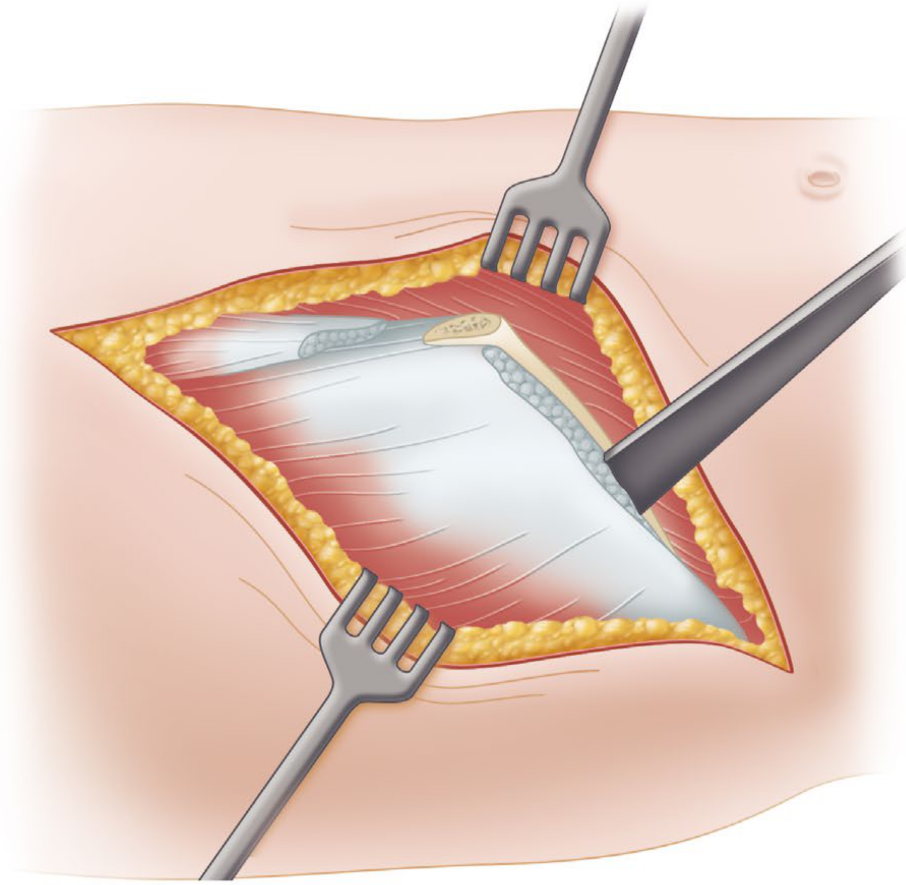 Surgical exposure during Ober-Yount procedure - tensor fasciae latae is being divided