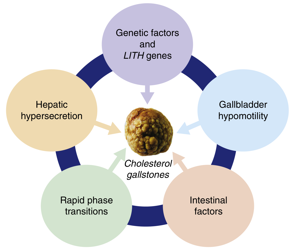 Five primary defects driving cholesterol gallstone formation - genetic factors/LITH genes, hepatic hypersecretion, gallbladder hypomotility, rapid phase transitions, and intestinal factors