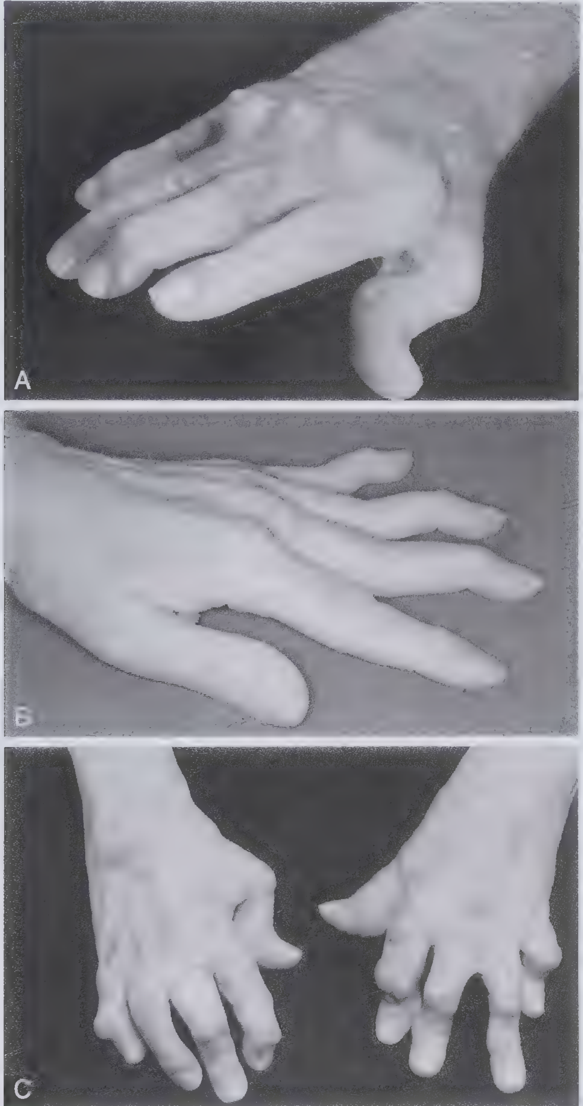 RA hand deformities - ulnar deviation, swan neck, boutonnière
