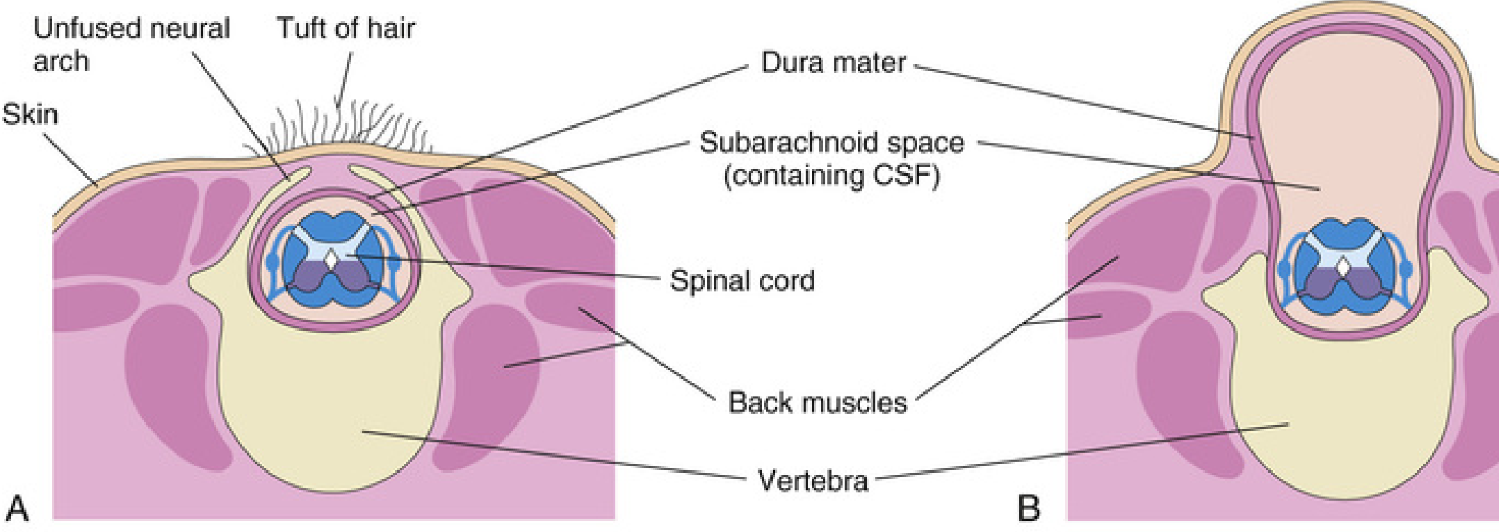 Cross-sectional diagrams showing spina bifida occulta (A, unfused neural arch with tuft of hair) and meningocele (B, meninges herniating through defect with CSF)