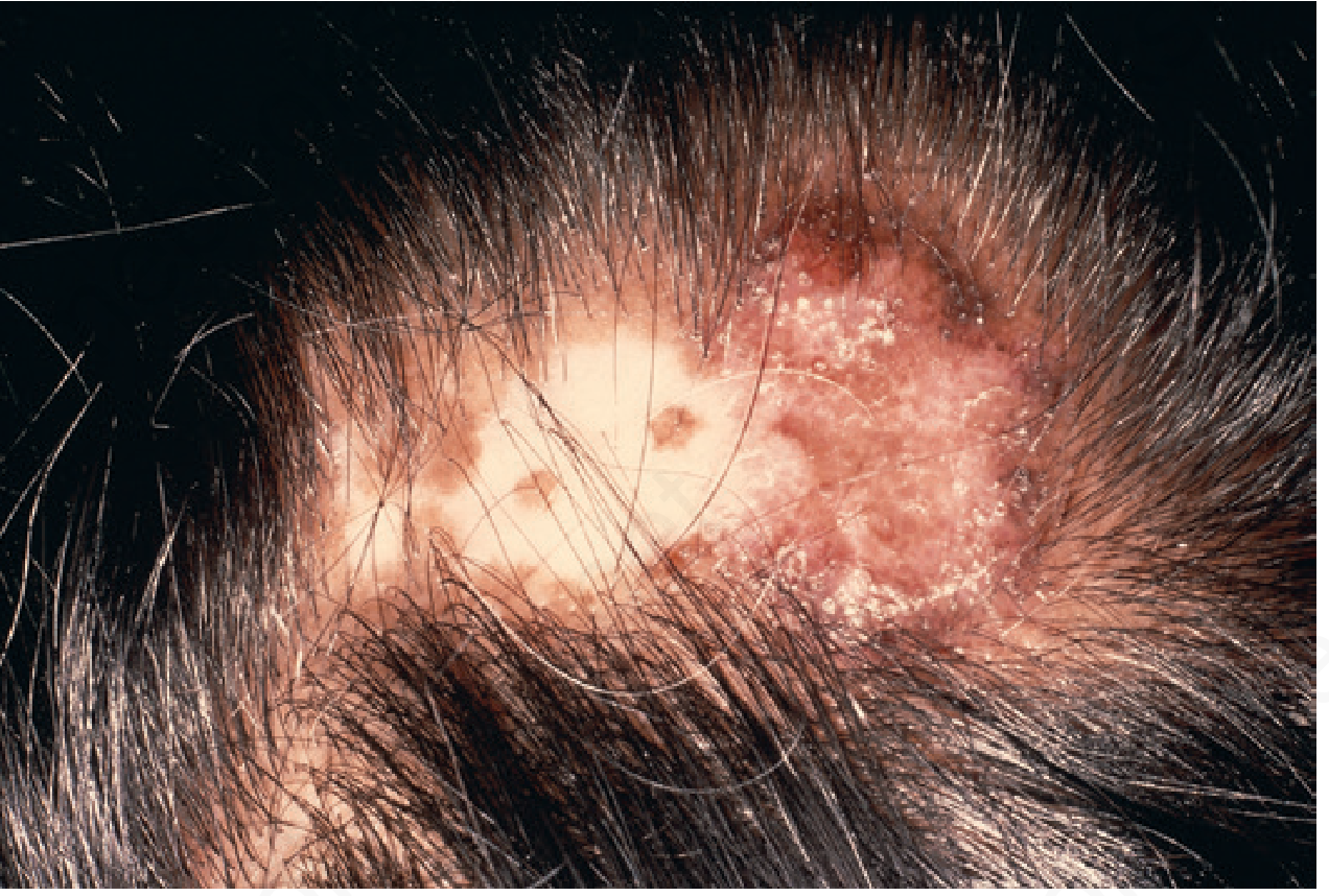 Scalp plaque with scarring alopecia, hyperpigmentation and depigmentation in discoid lupus erythematosus - Andrews' textbook clinical image