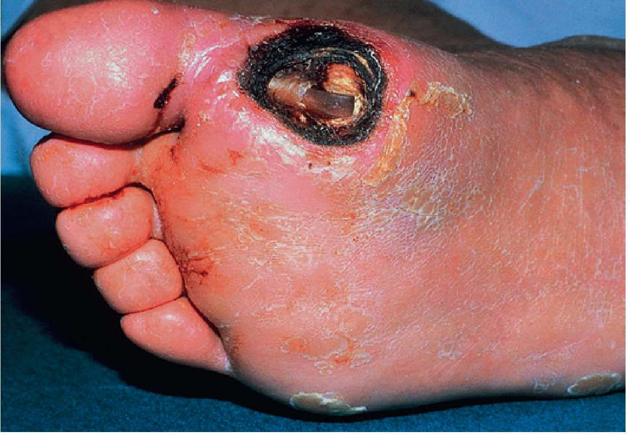 Diabetic foot ulcer - severely inflamed and ulcerated area on the top of a foot