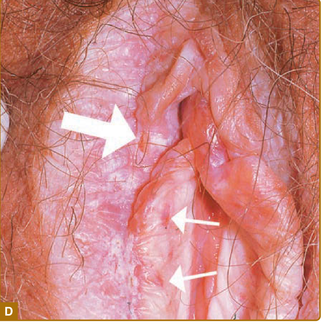 Lichen sclerosus - white vulvar plaque with purpura and erosions