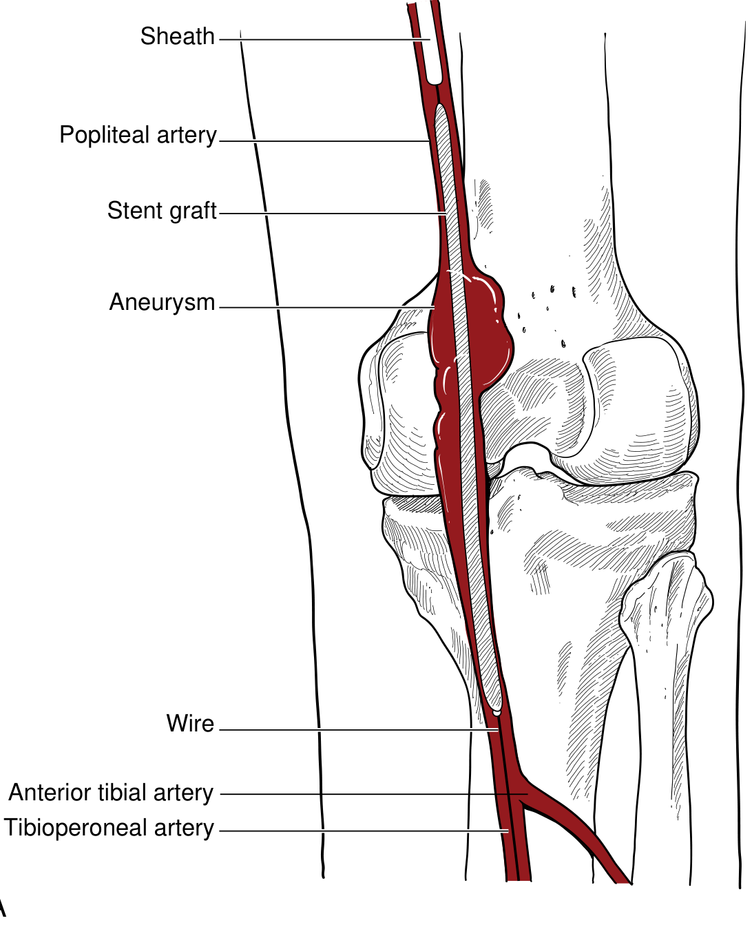 Covered stent excluding PAA - diagram