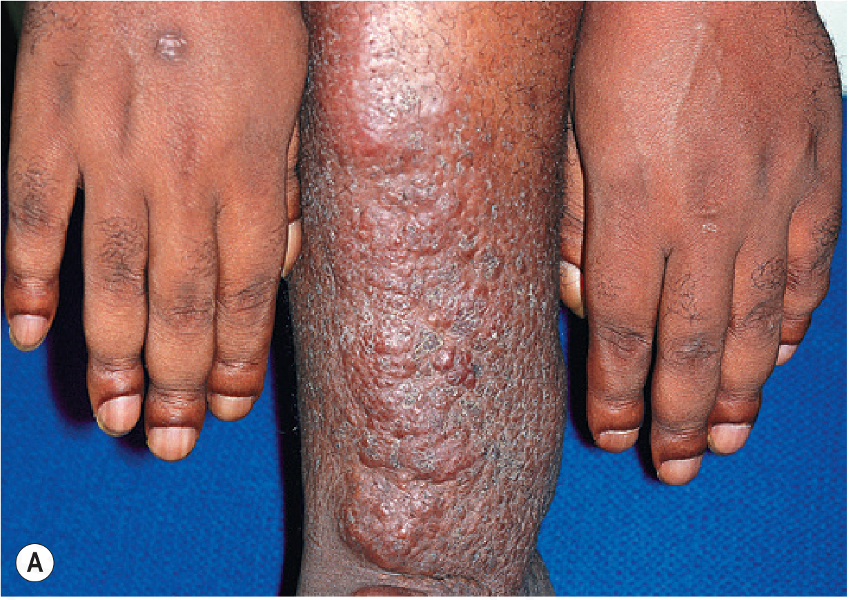 Thyroid acropachy and pretibial myxedema in Graves disease