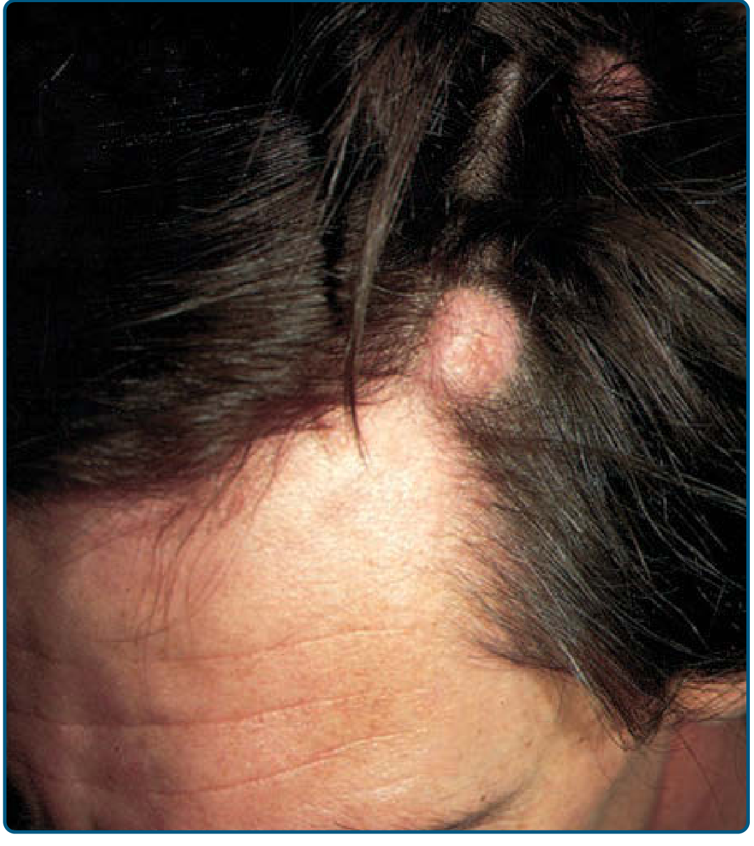 Trichilemmal (pilar) cyst on the scalp — mobile, firm, dome-shaped nodule at the hairline