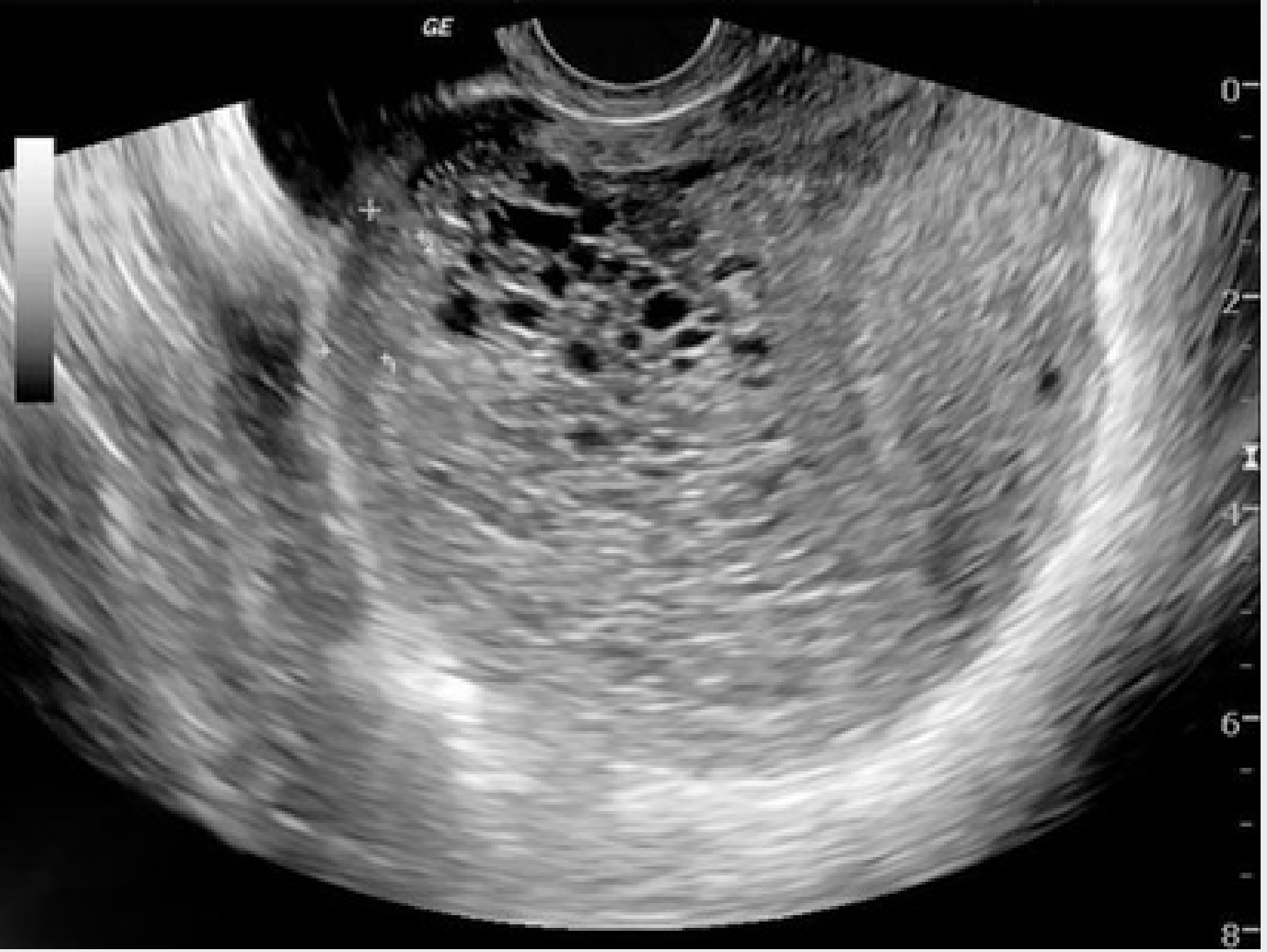 Ultrasound image of complete hydatidiform mole showing the "cluster of grapes sign" with numerous small cystic spaces