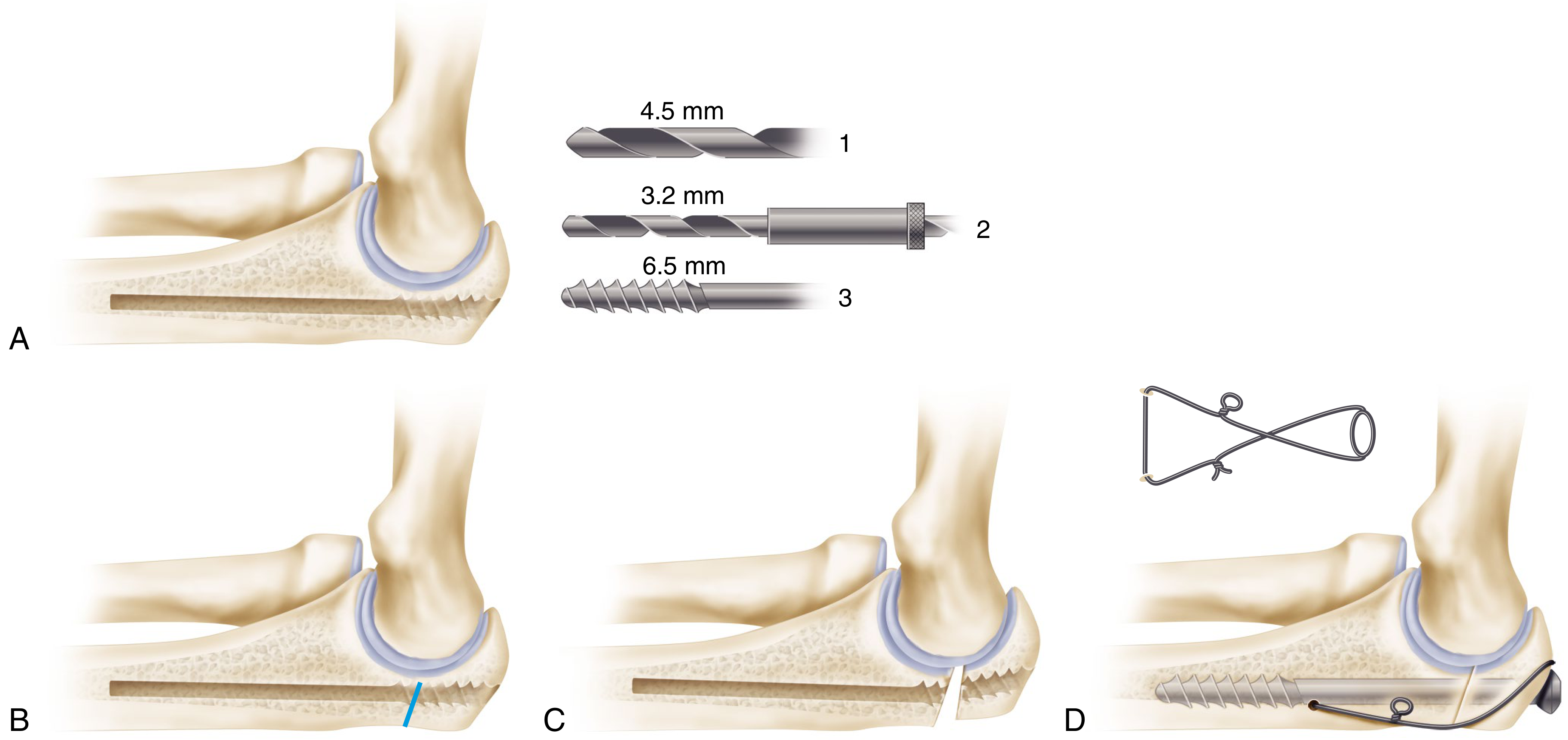 Olecranon osteotomy technique: (A) Pre-drilling for 6.5mm screw, (B) Incomplete chevron osteotomy, (C) Completed by fracture, (D) Lag screw and tension band wire fixation
