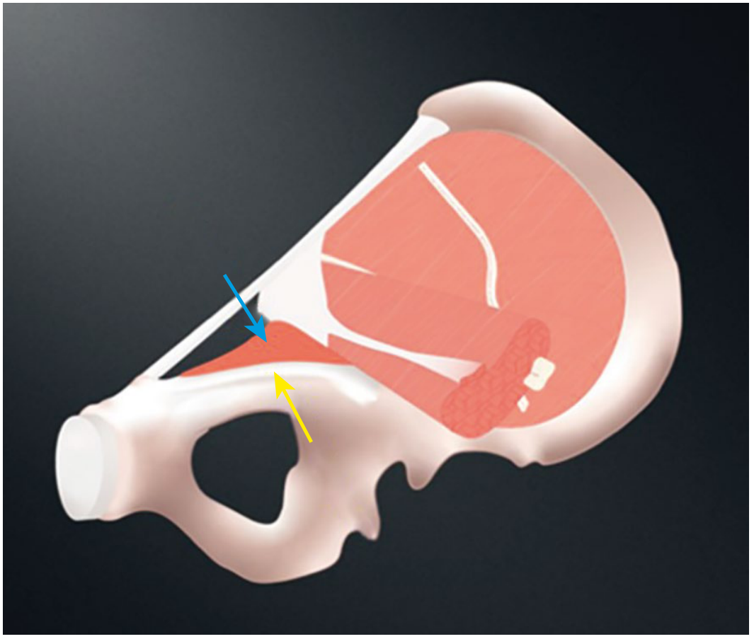 Cooper's ligament (yellow arrow) formed by the tendon of the pectineus muscle (blue arrow)