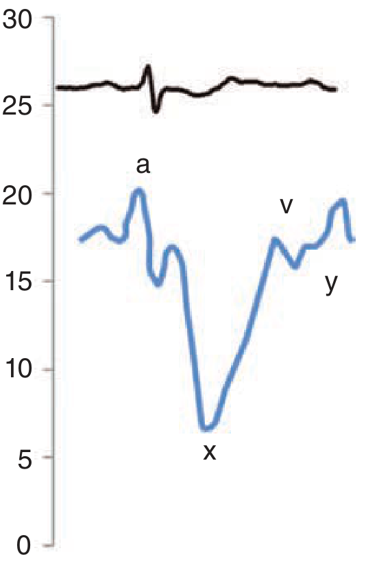 Normal JVP waveform with a, x, v, y — synchronized with ECG