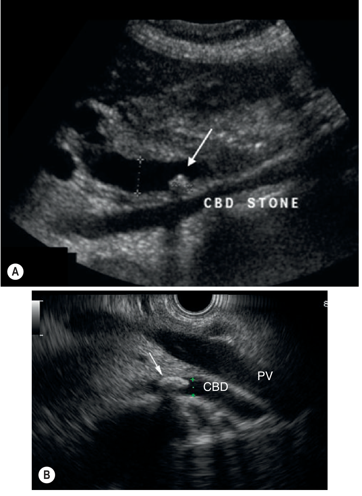 CBD Stone on Ultrasound and EUS