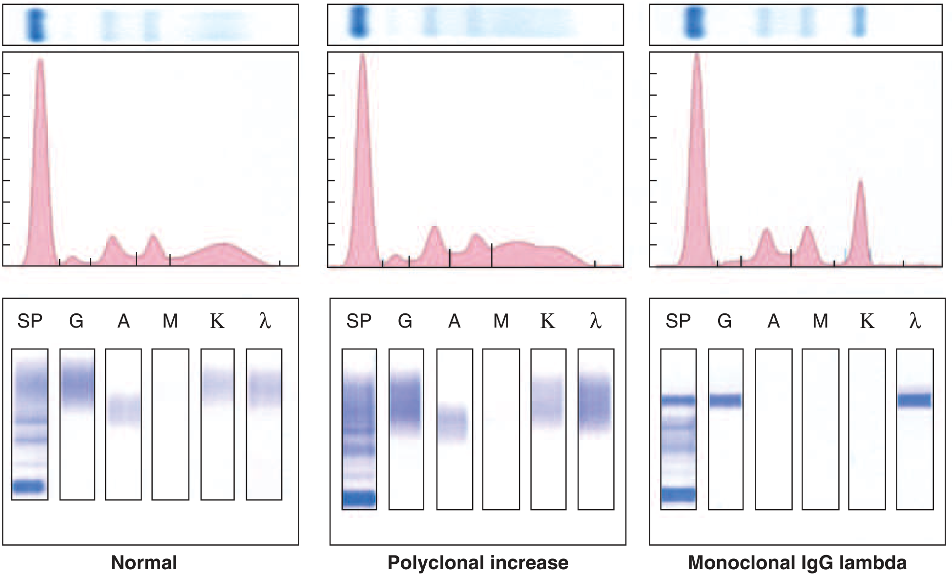 Representative patterns of serum electrophoresis and immunofixation - Normal, Polyclonal increase, and Monoclonal IgG lambda