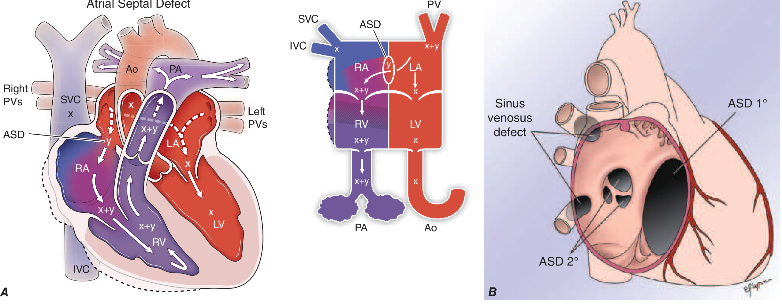 ASD left-to-right shunt diagram and types of ASD