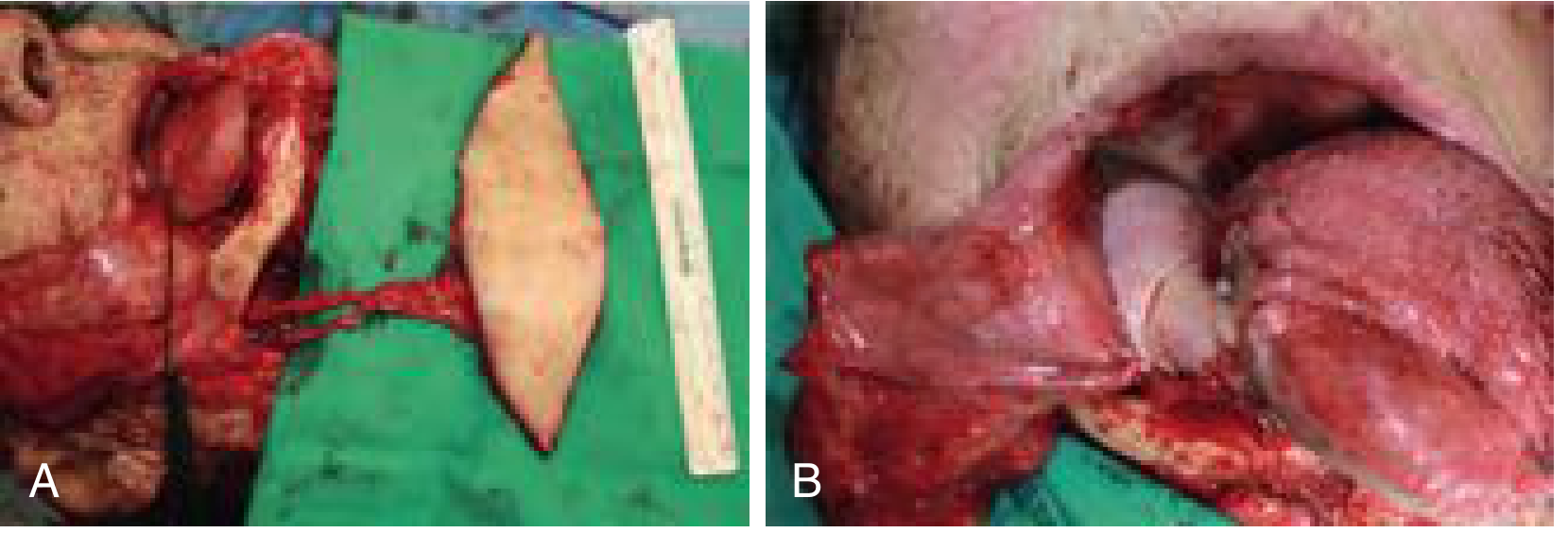 Submental island flap harvest (A) and inset into lateral pharynx/oropharyngeal defect (B)