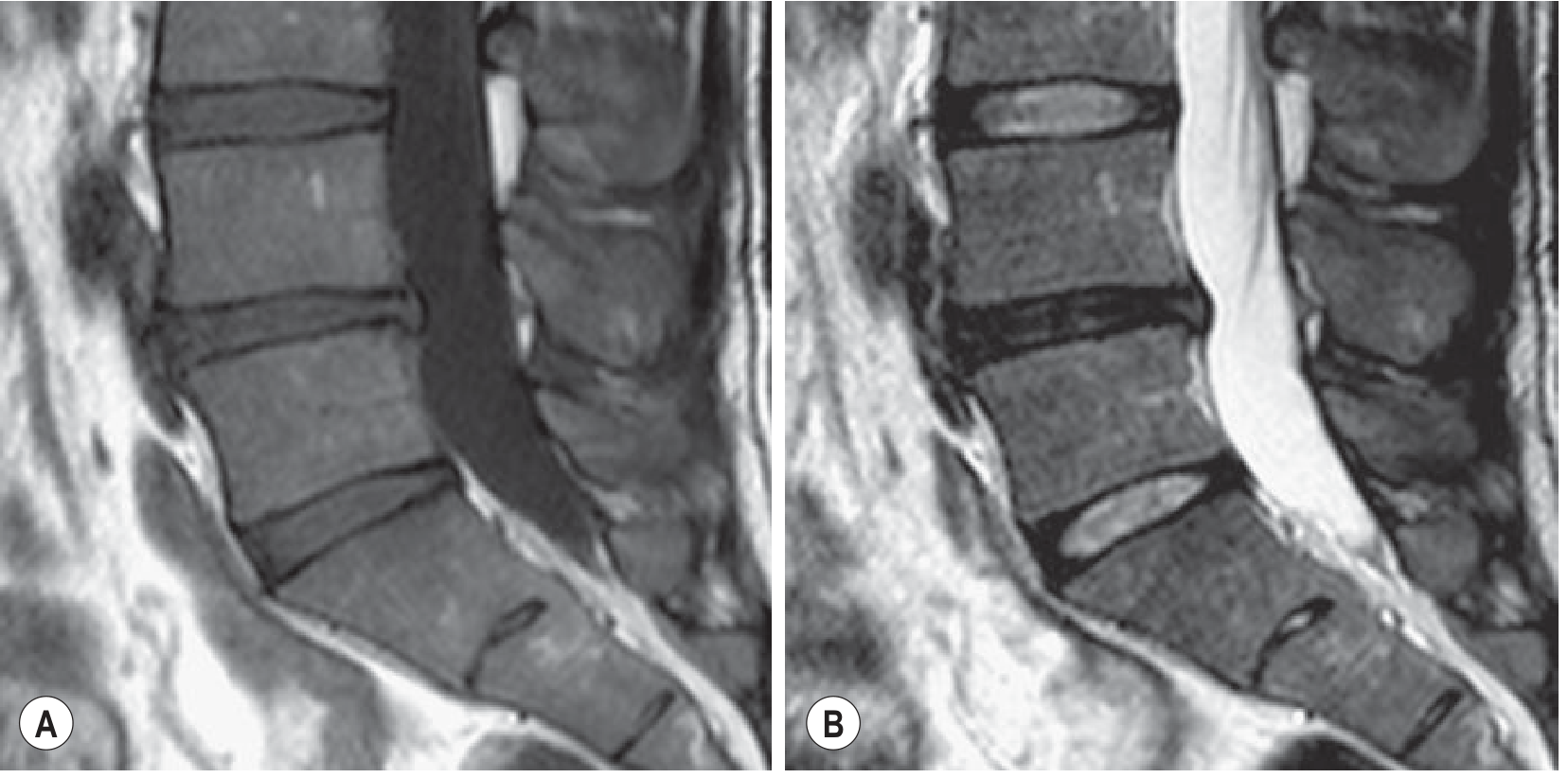 Black disc - sagittal T2 MRI showing decreased signal at L4-L5 indicating disc desiccation