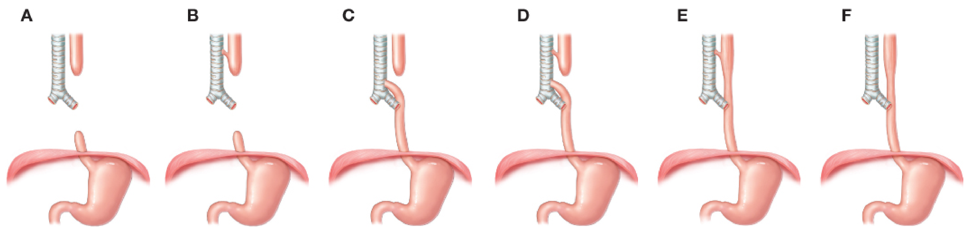 Gross classification of EA/TEF types A through F - anatomical patterns showing esophageal and tracheal configurations