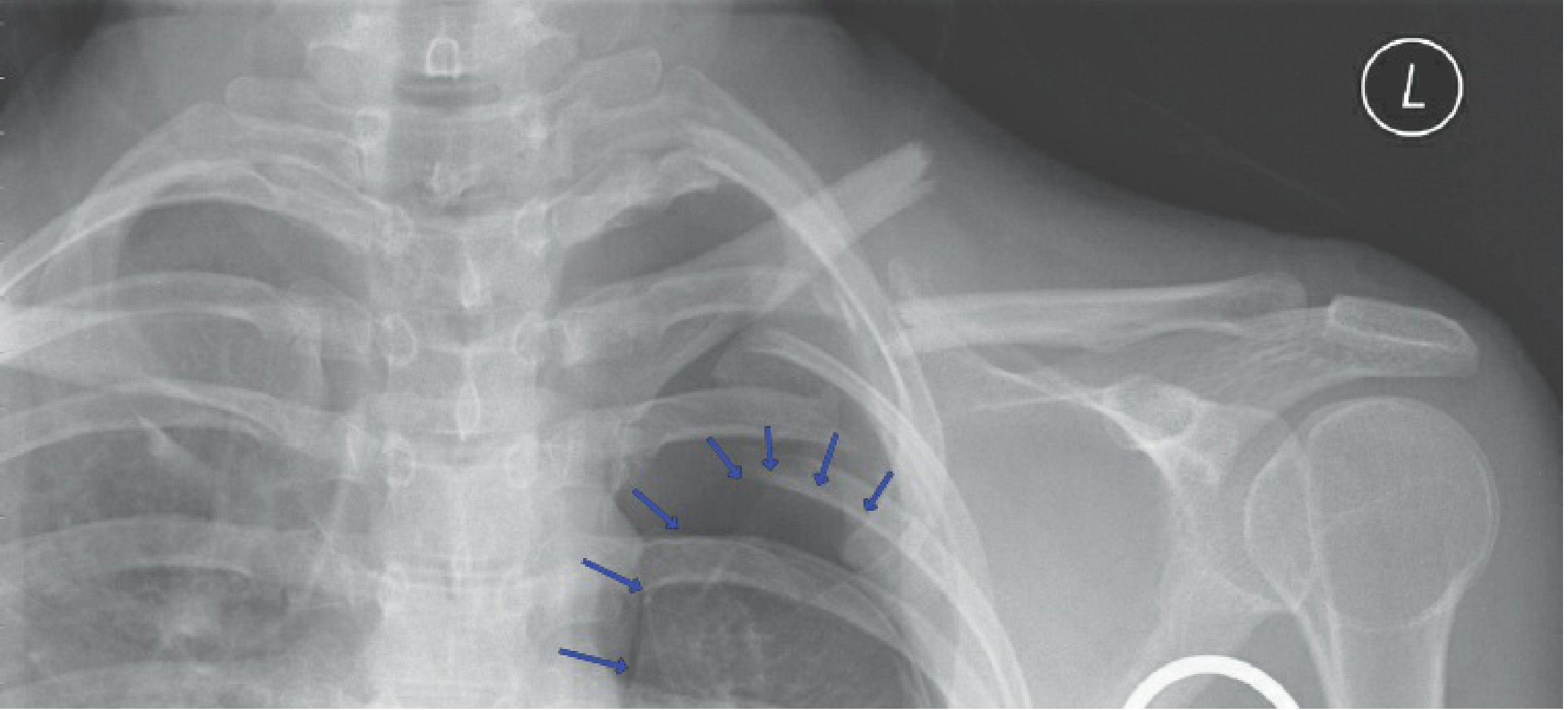 AP chest X-ray showing displaced left clavicle fracture with associated upper rib fractures and pneumothorax