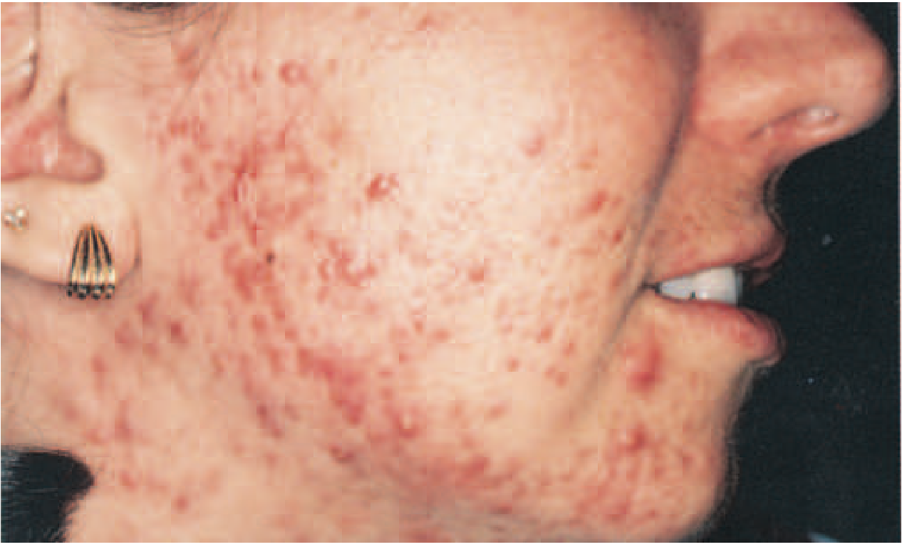 Acne vulgaris with inflammatory papules, pustules, and comedones