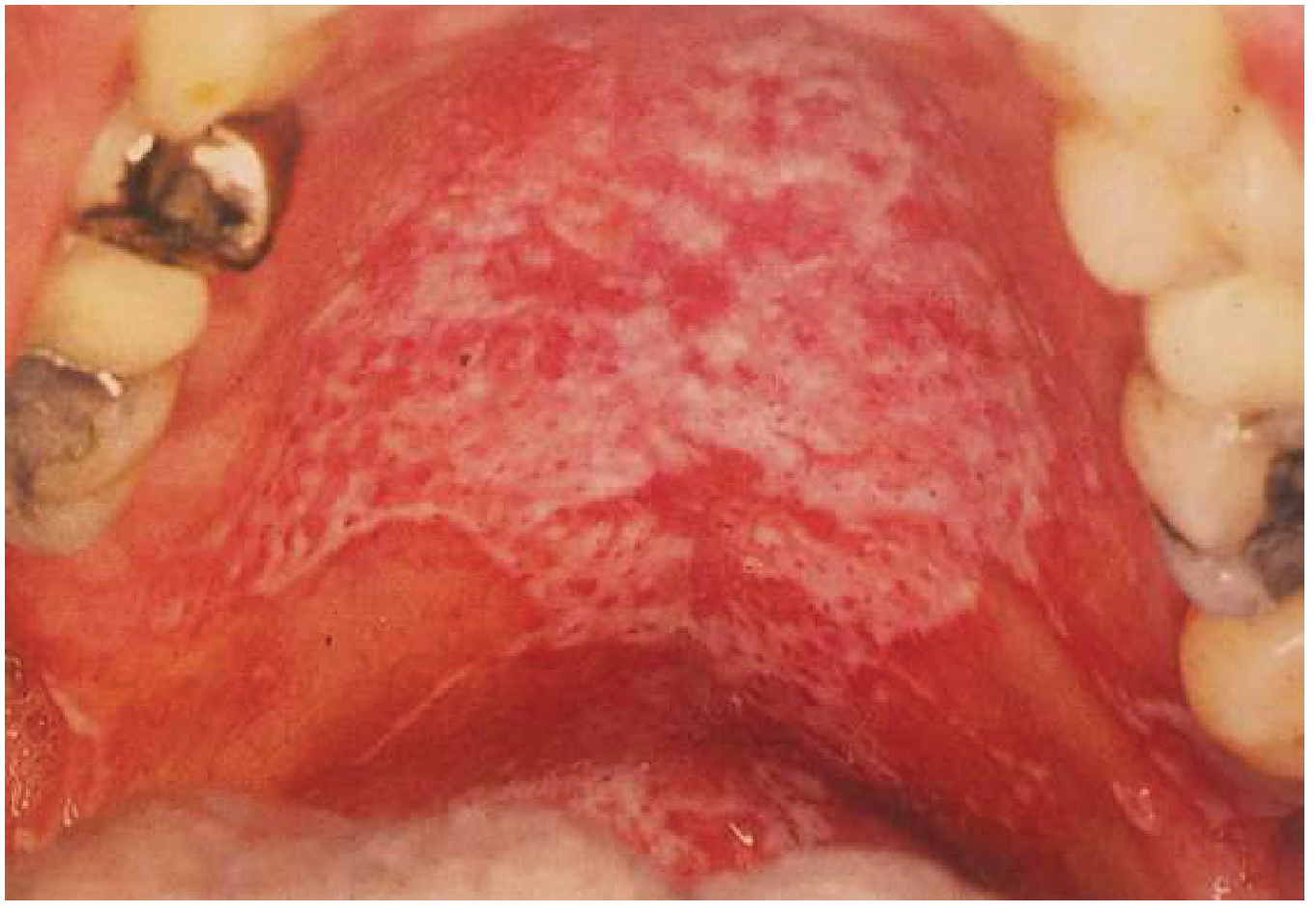 Oral candidiasis thrush - creamy white removable plaques on palate in HIV patient