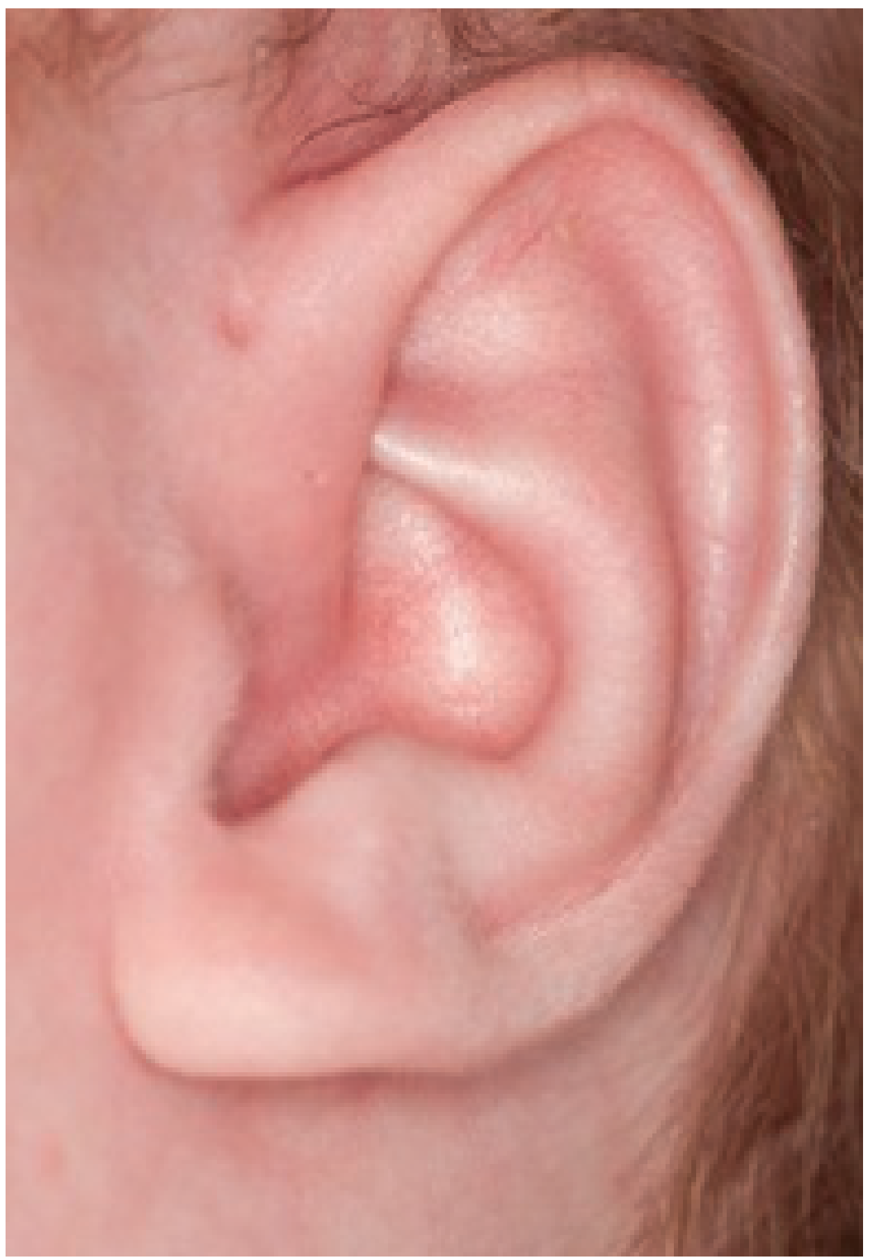 Left preauricular sinus - small pit anterior to helix