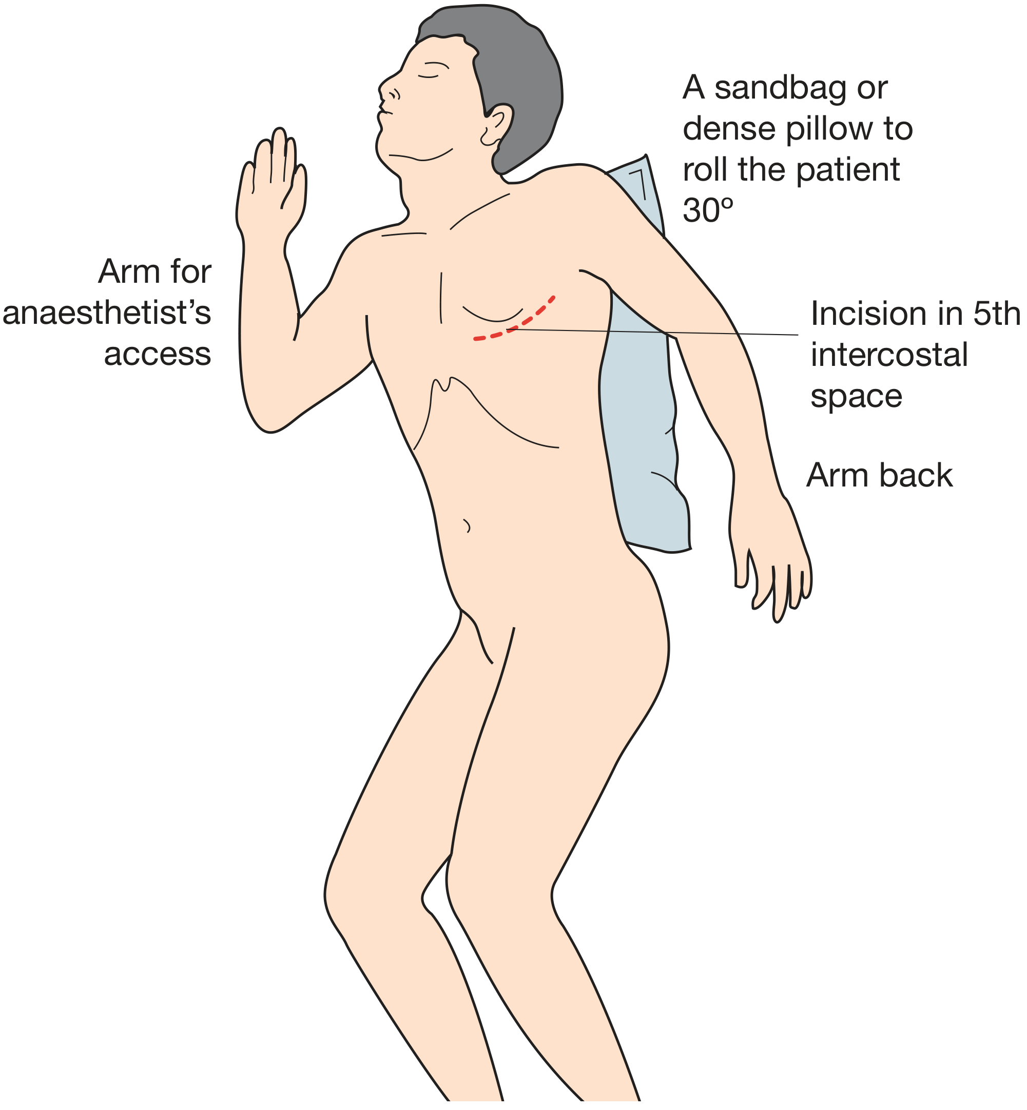 Emergency anterolateral thoracotomy positioning - patient rolled 30°, incision in 5th ICS