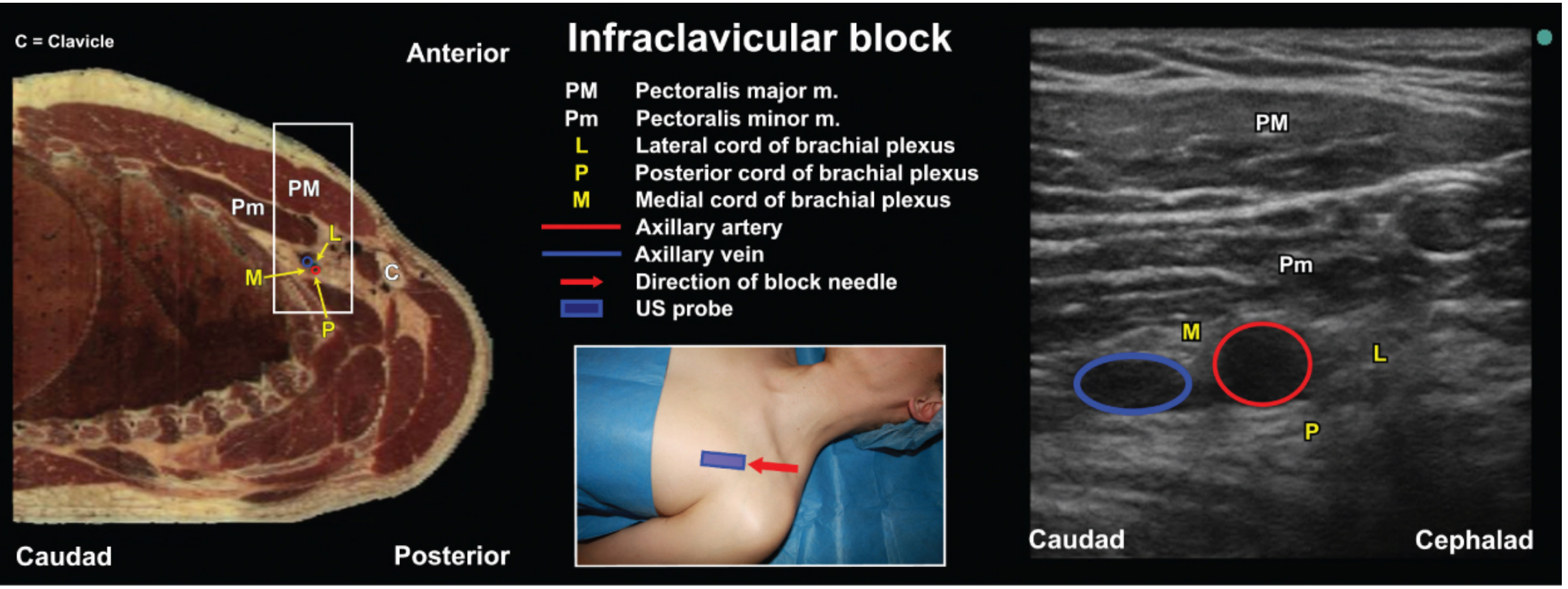 Infraclavicular block anatomy with cross-section, patient positioning, and ultrasound image showing PM=Pectoralis major, Pm=Pectoralis minor, L=Lateral cord, P=Posterior cord, M=Medial cord, red=axillary artery, blue=axillary vein