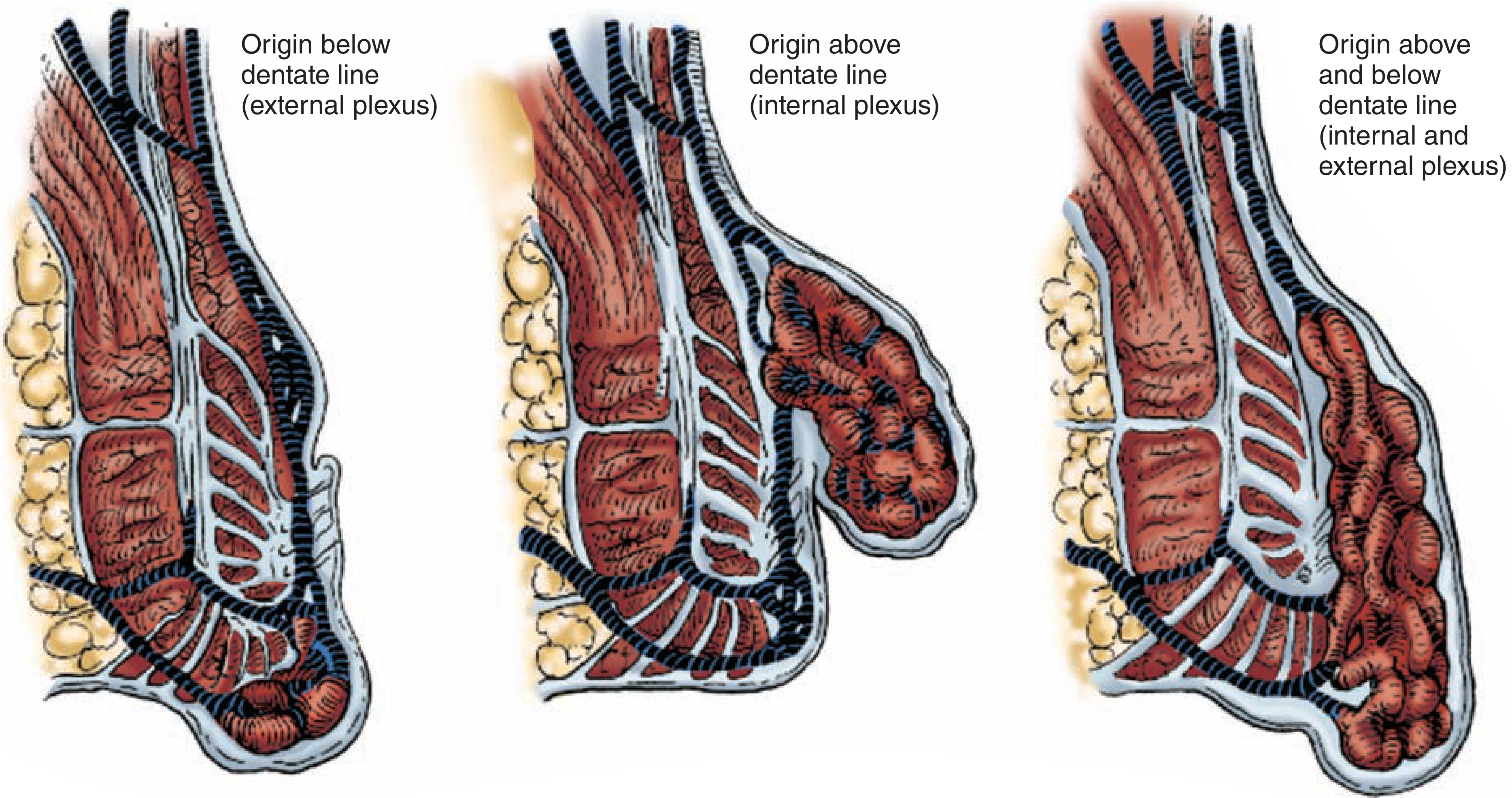 Types of haemorrhoids - external (origin below dentate line), internal (origin above dentate line), and mixed (origin above and below)