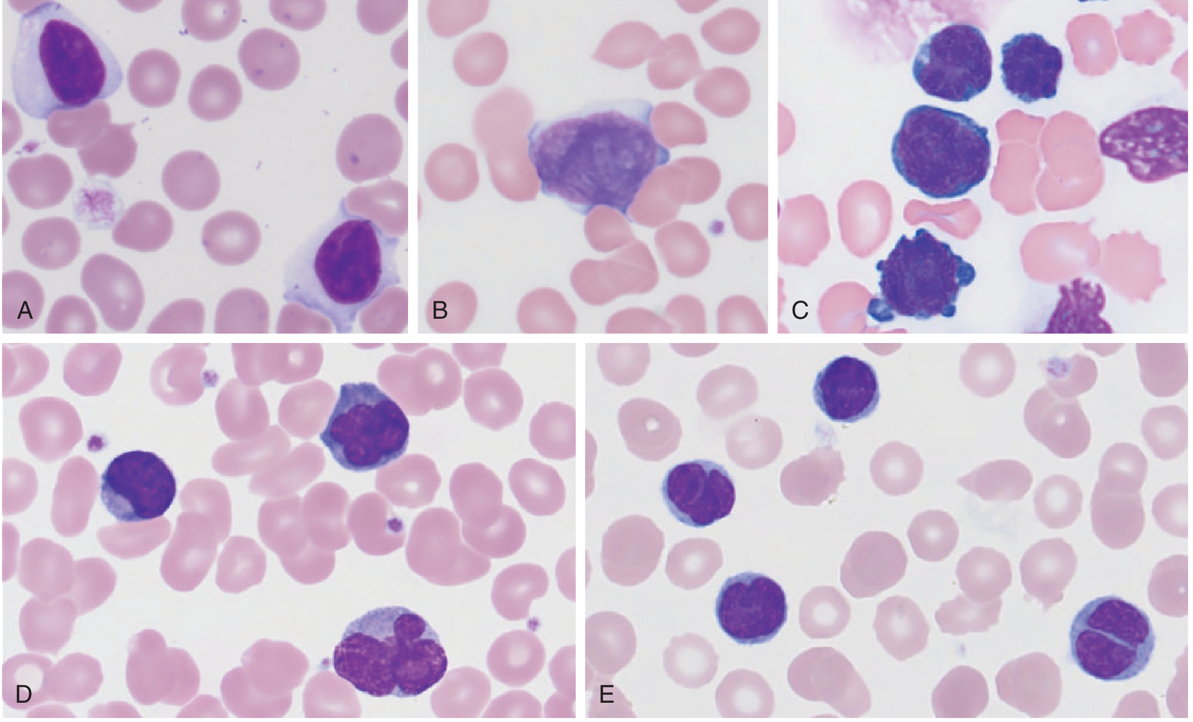Peripheral blood smear of T-cell lymphoproliferative disorders: (A) T-LGL leukemia; (B) Sézary cell with convoluted cerebriform nucleus - note the deeply infolded, brain-like nuclear contour; (C) T-PLL; (D-E) additional variants