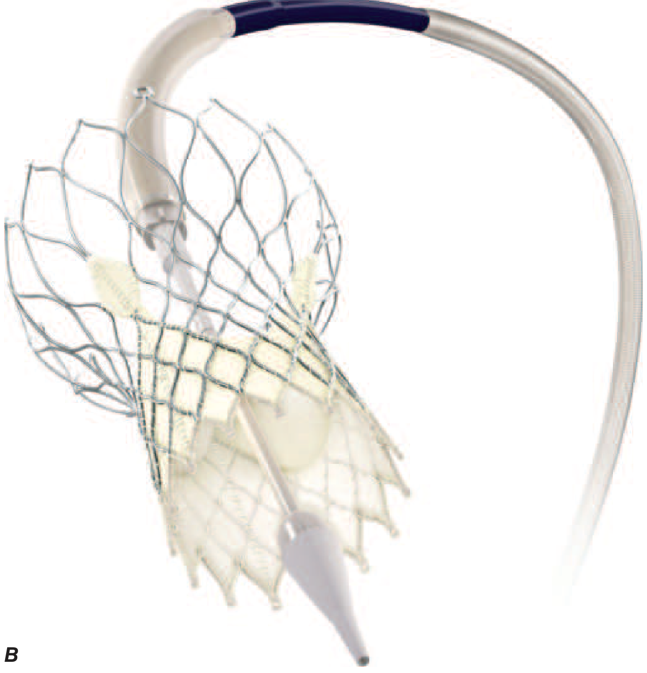 Self-expanding CoreValve TAVI prosthesis - large nitinol mesh frame with pericardial tissue leaflets and flared skirt at base