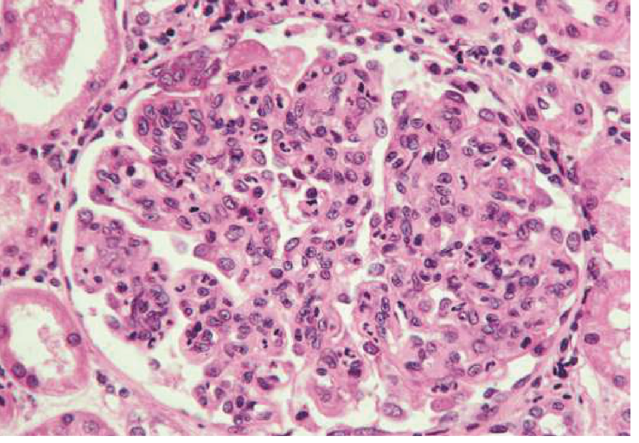 Post-streptococcal glomerulonephritis - hypercellular glomerulus infiltrated by numerous polymorphonuclear leukocytes (H&E, light microscopy)