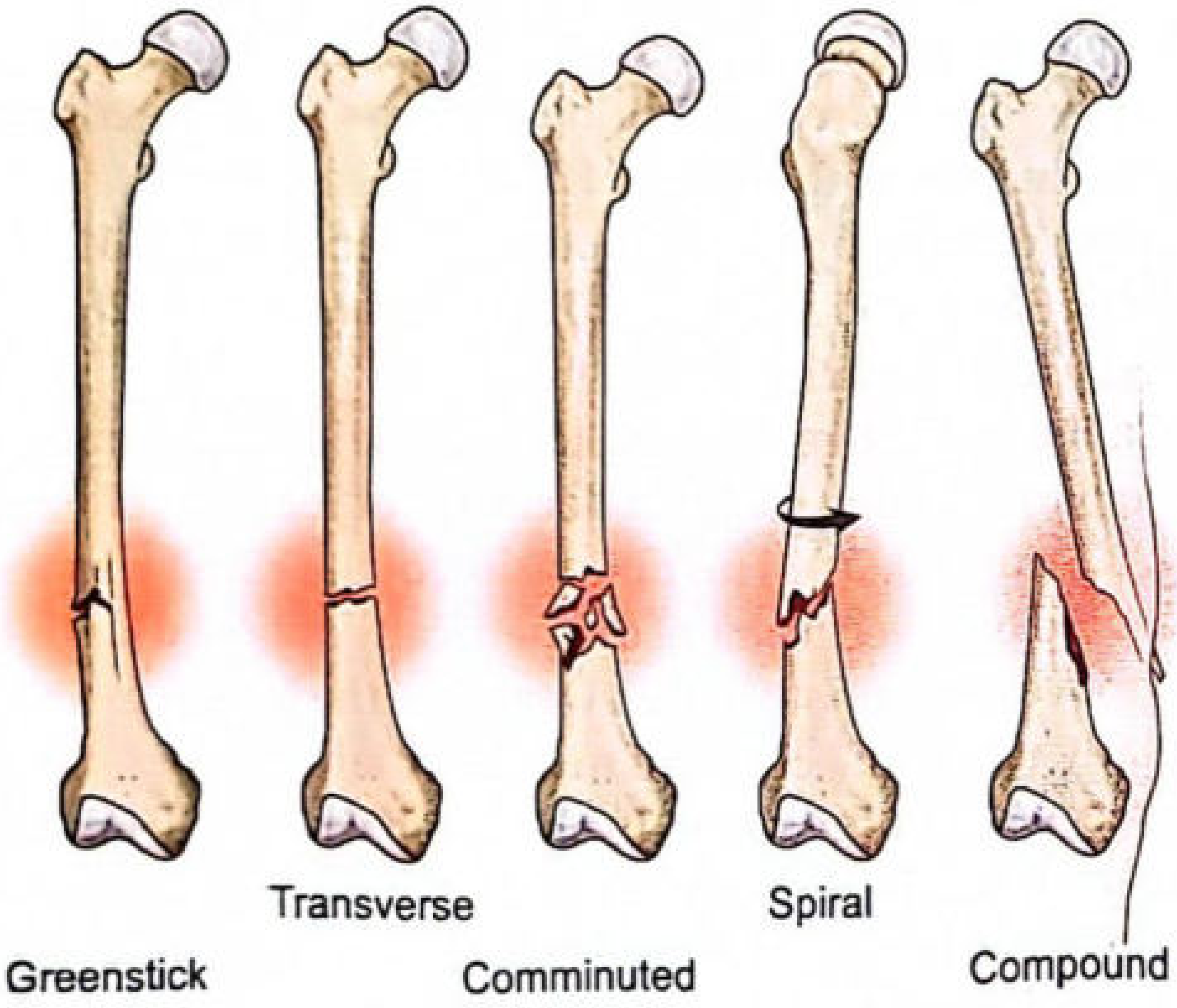 Types of bone fractures - Greenstick, Transverse, Comminuted, Spiral, Compound