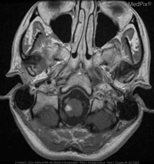 MRI T2 axial showing right dorsolateral medullary hyperintensity - hallmark of Wallenberg syndrome/PICA territory infarct