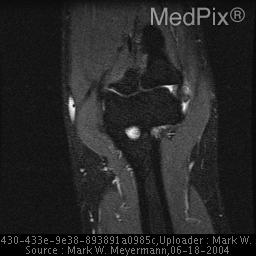 MRI coronal view showing lateral epicondylitis with hyperintense signal at common extensor origin