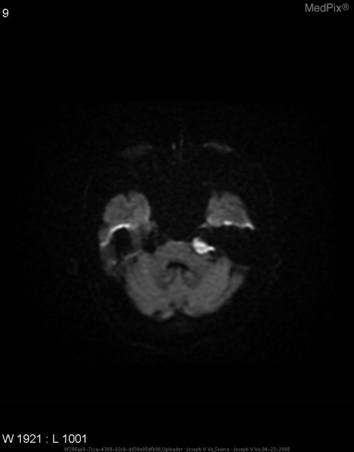 CPA epidermoid DWI: bright signal in left CPA - restricted diffusion characteristic; lobulated "creeping" morphology filling cisterns