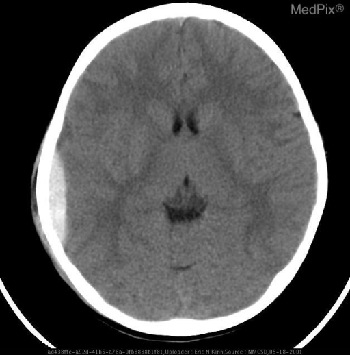 Epidural hematoma