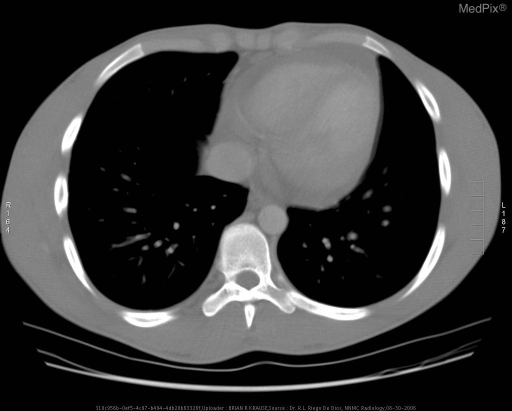 Anterior mediastinal mass - homogeneous CT density consistent with lymphoma