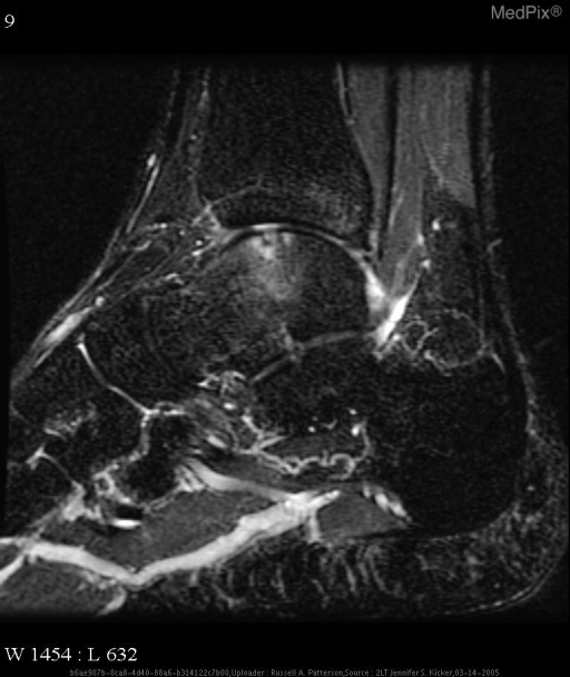 Sagittal T2 fat-saturated MRI of the ankle showing joint effusion